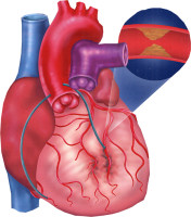 coronary artery bypass