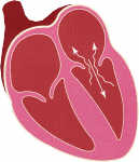 mitral regurgitation